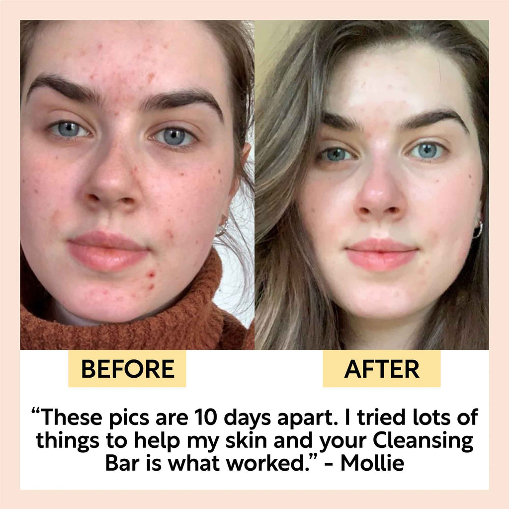 Split before-and-after face photos showing skin clarity after using a cleansing bar
