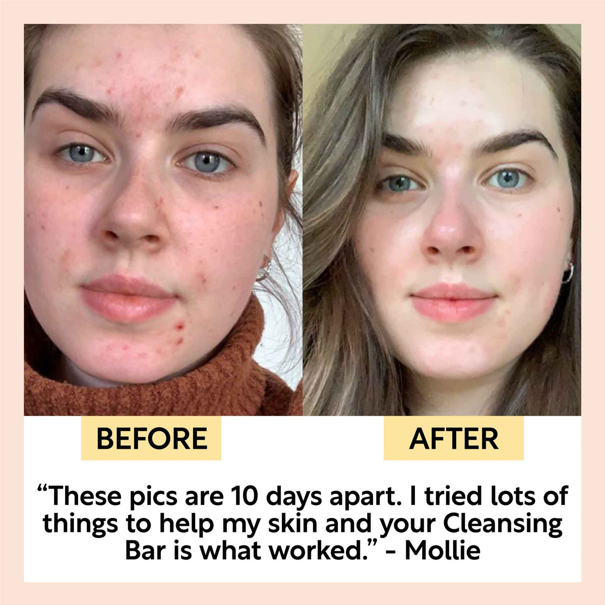 Split before-and-after face photos showing skin clarity after using a cleansing bar
