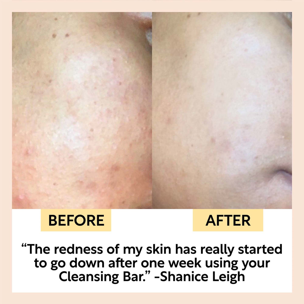Before-and-after close-up face showing reduced redness after using a cleansing bar