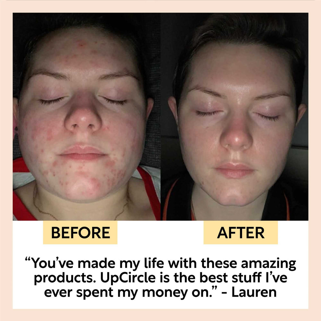 Before-and-after skin photos with face views labeled before and after