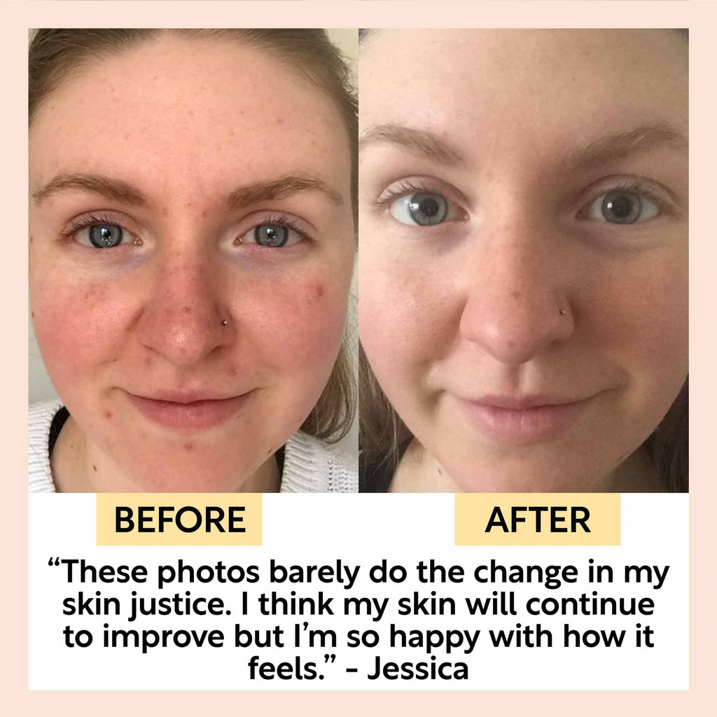 Before-and-after skin photos showing facial change labeled before and after