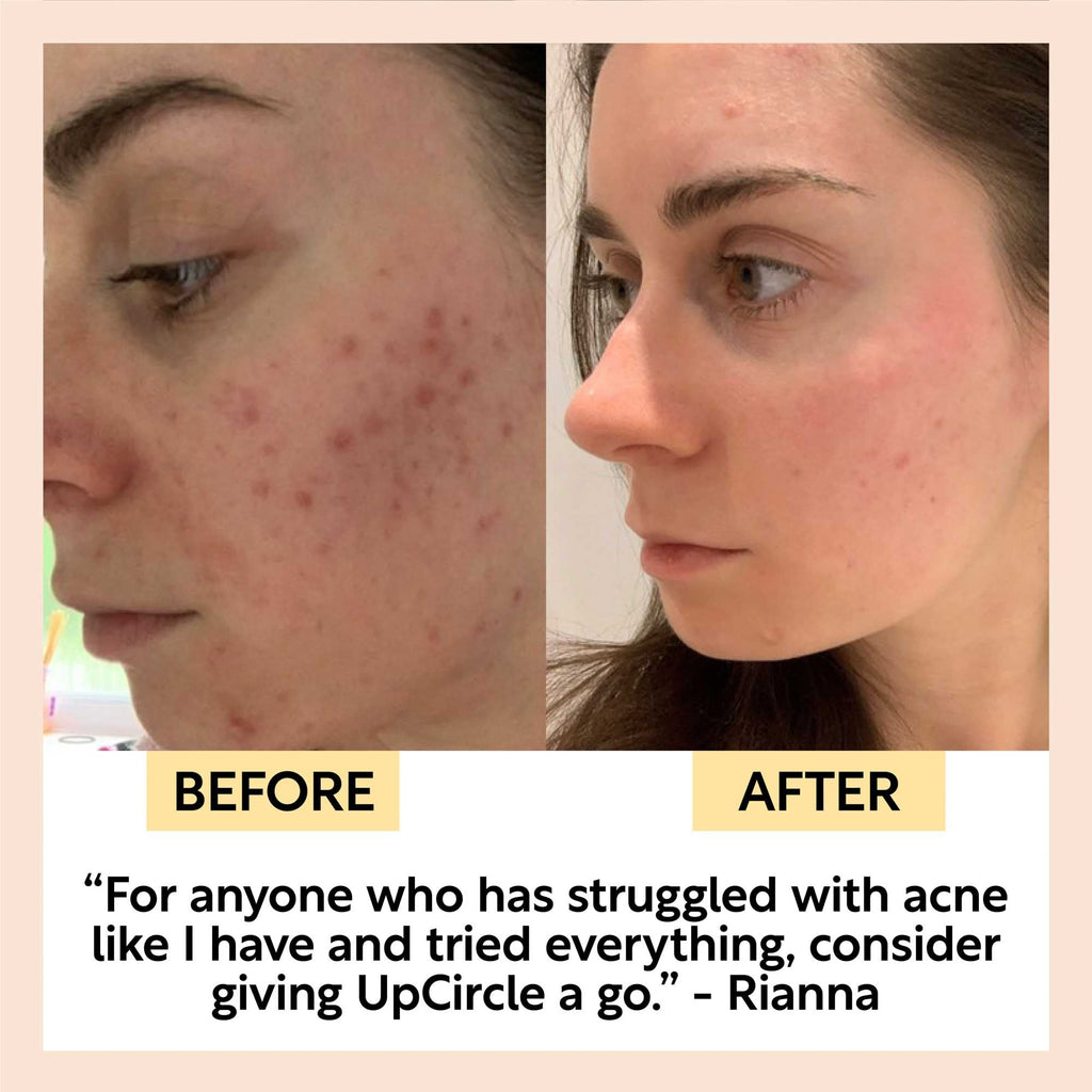 Before-and-after skincare results on face side views, showing clearer skin