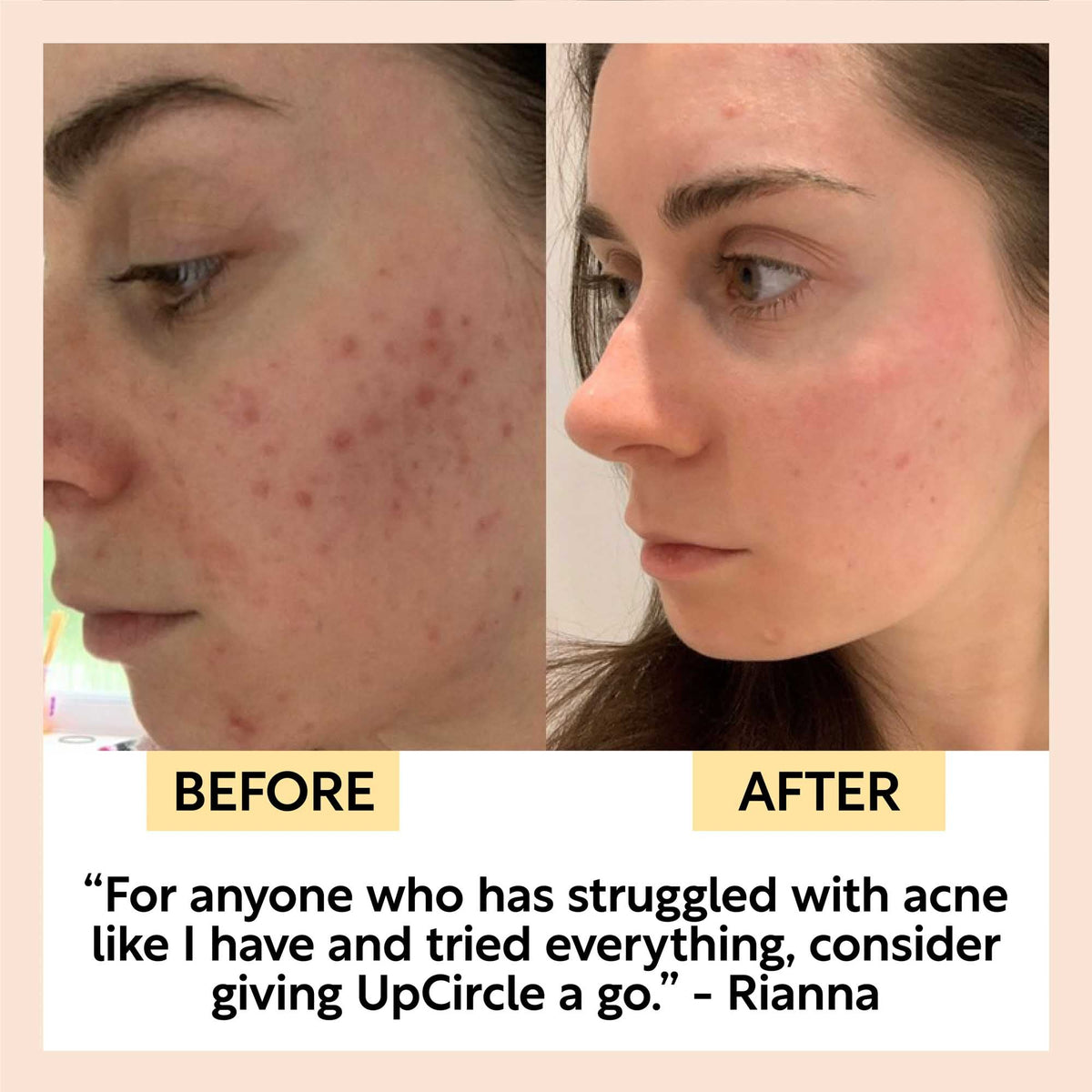 Before-and-after skincare results on face side views, showing clearer skin