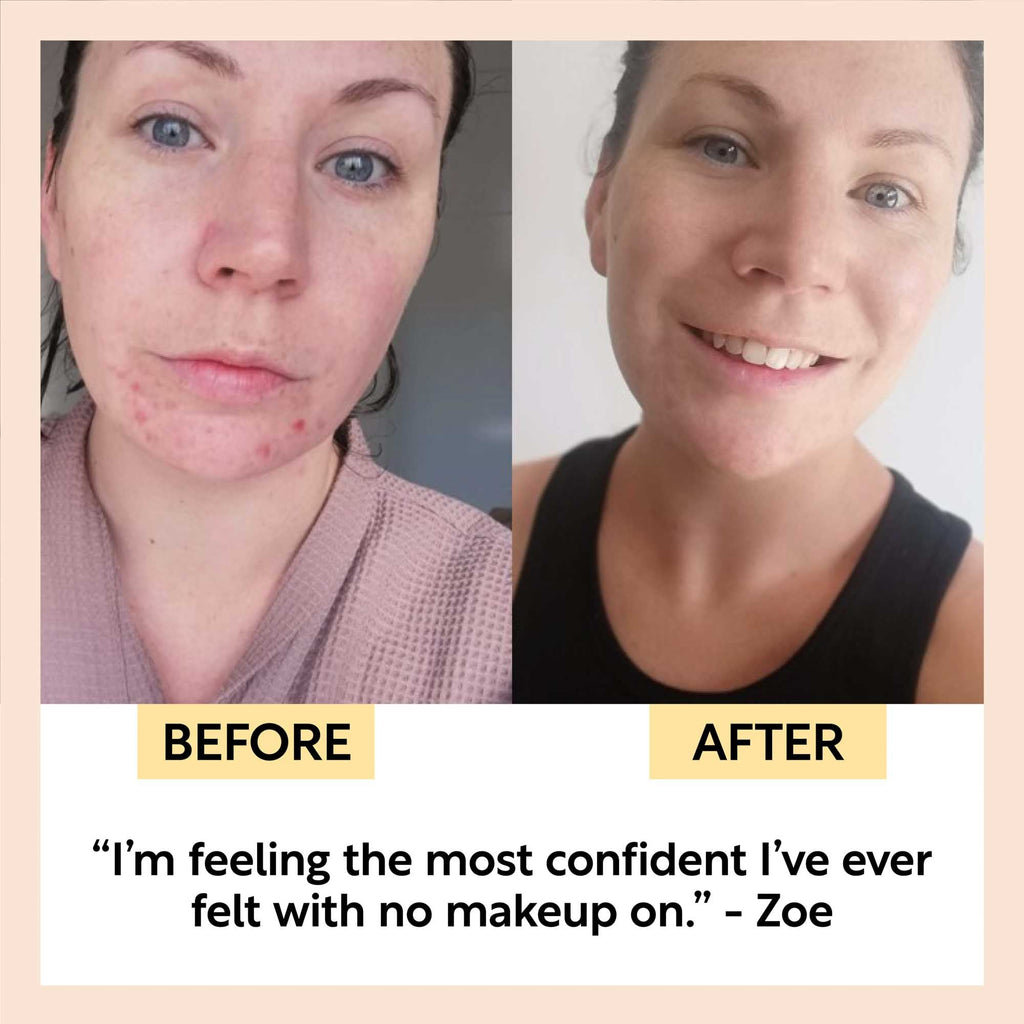 Before-and-after skincare results on two faces, clearer and smoother complexion