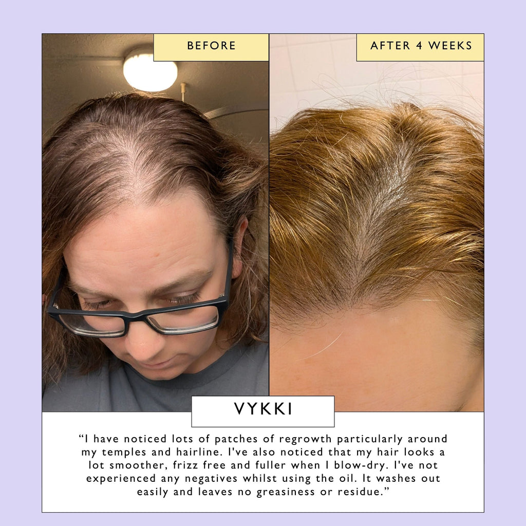 Split before-and-after close-up of scalp hairline and regrowth