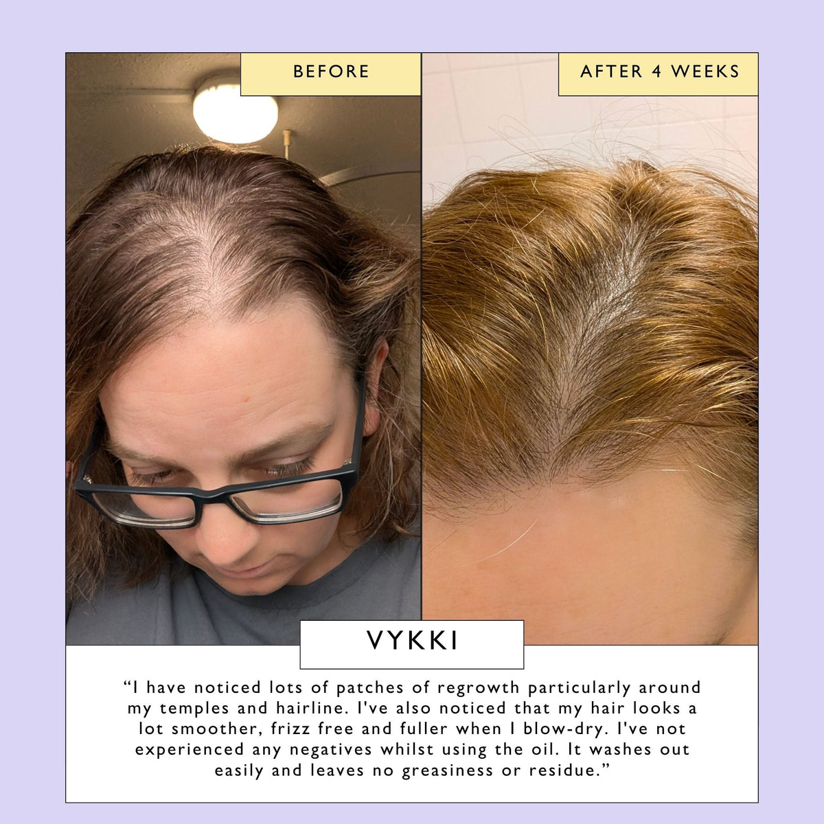 Split before-and-after close-up of scalp hairline and regrowth
